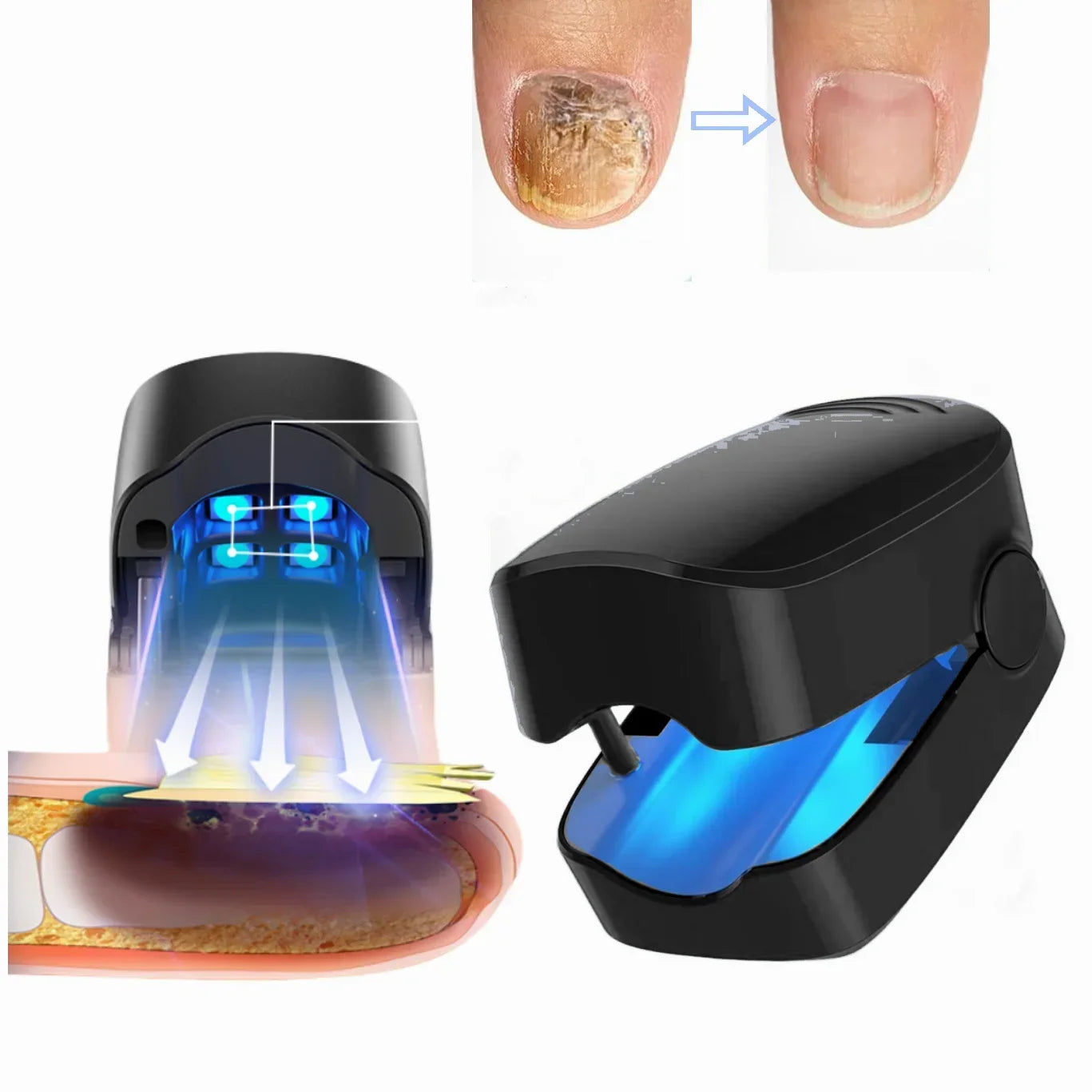 Nail Fungus Treatment LED Laser Device for Cleaning