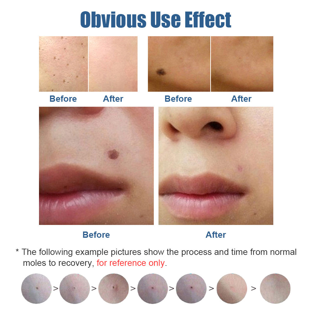 Mini Laser Plasma Pen Portable Freckle Removal Machine