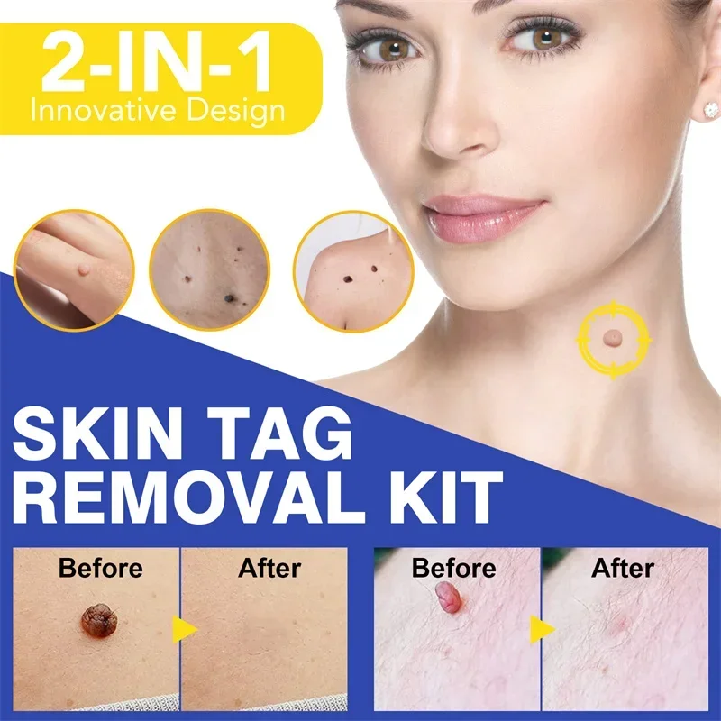 1 Set Skin Tag Removal Kit Skin Mole Wart Remover