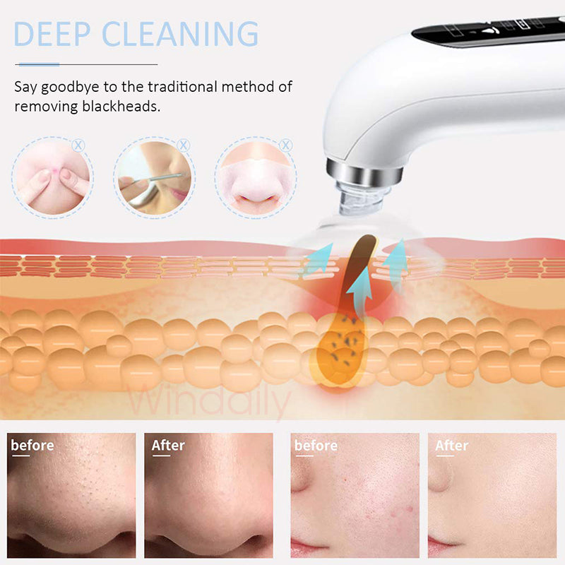 Blackhead Remover Pore Vacuum Cleaner Electric